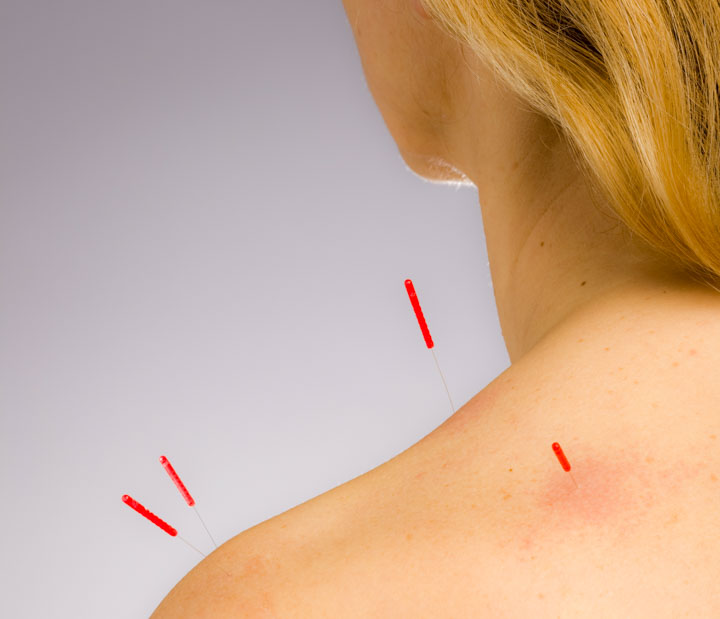 acupuncture helps to relieve spasticity for stroke patients