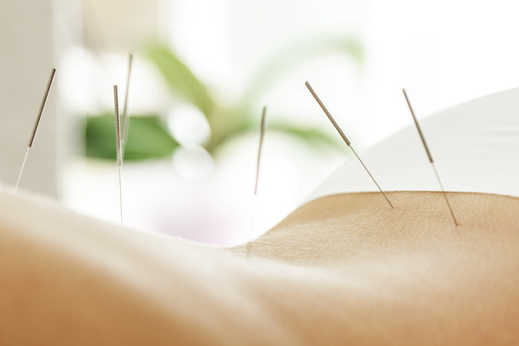 acupuncture plus herbs beats gastroesophageal reflux disease, gerd