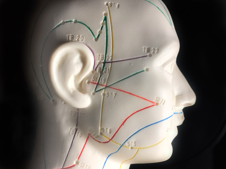 acupuncture used as a standalone therapy for migraine severity